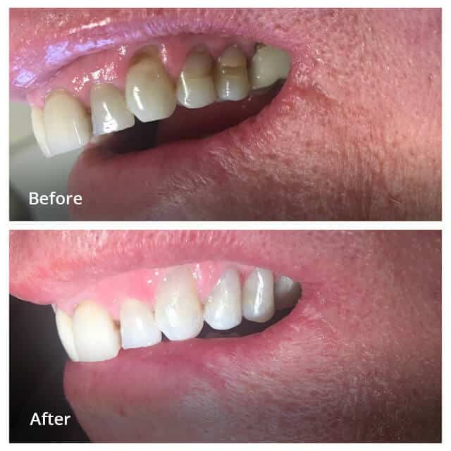 Dental Work Before & After - Dentist in San Diego CA - Radiant Dental Arts