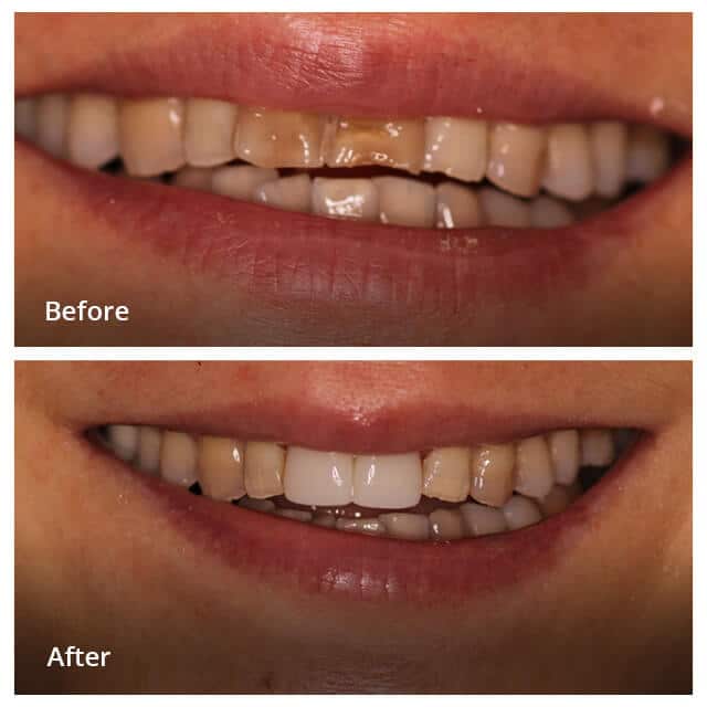 Dental Work Before & After - Dentist in San Diego CA - Radiant Dental Arts