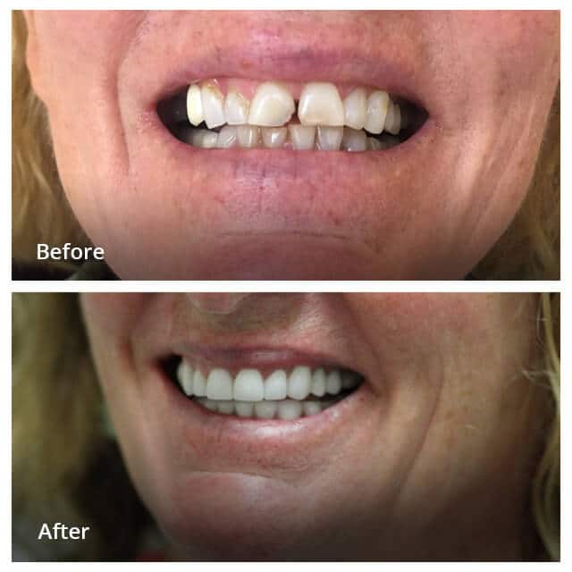 Dental Work Before & After - Dentist in San Diego CA - Radiant Dental Arts