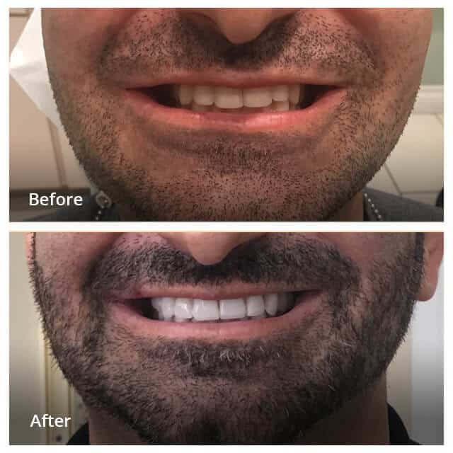 Dental Work Before & After - Dentist in San Diego CA - Radiant Dental Arts