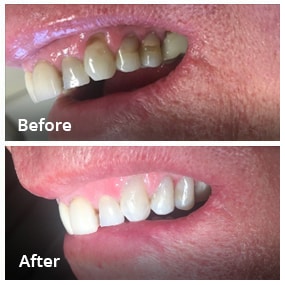 Dental Work Before & After - Dentist in San Diego CA - Radiant Dental Arts