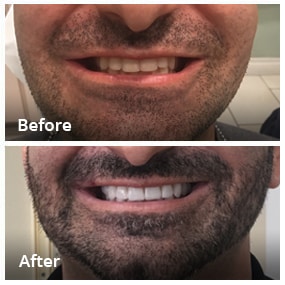 Dental Work Before & After - Dentist in San Diego CA - Radiant Dental Arts