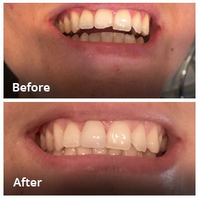 Dental Work Before & After - Dentist in San Diego CA - Radiant Dental Arts