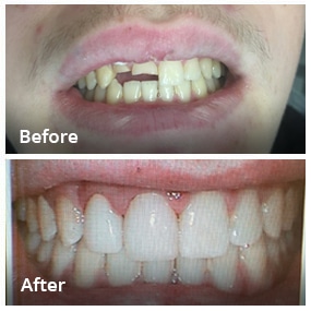 Dental Work Before & After - Dentist in San Diego CA - Radiant Dental Arts