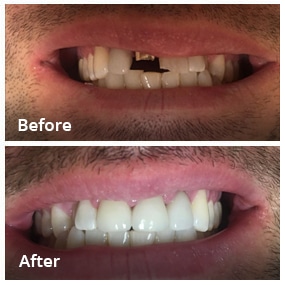 Dental Work Before & After - Dentist in San Diego CA - Radiant Dental Arts