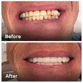 Dental Work Before & After - Dentist in San Diego CA - Radiant Dental Arts