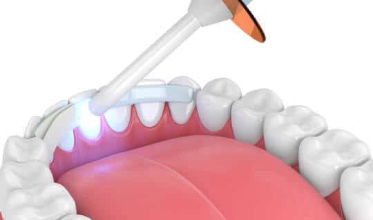 Cosmetic-Bonding