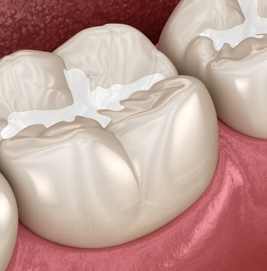 SEALANTS