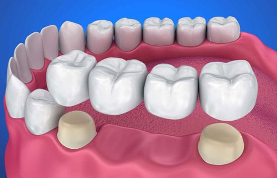 dental bridge