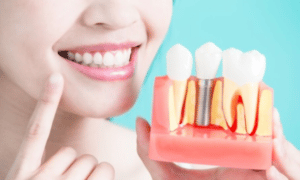 Dental Implants