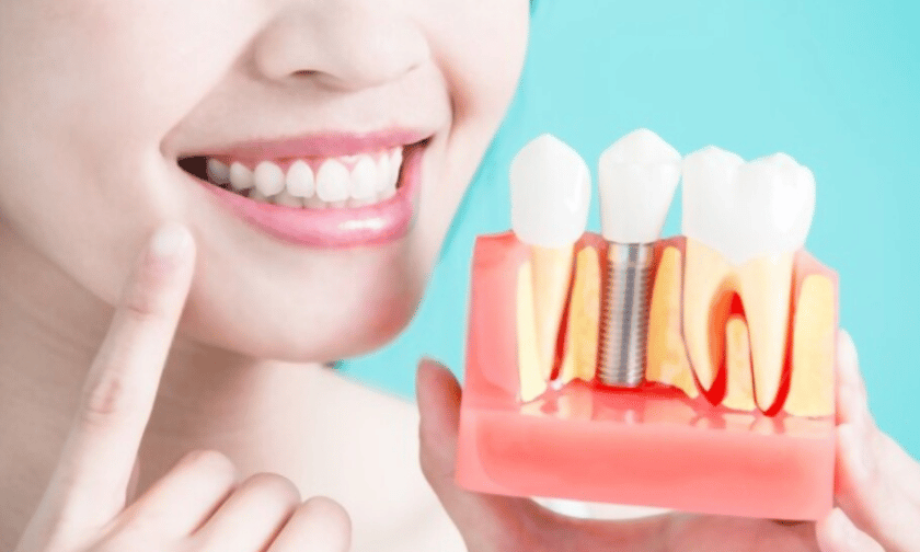 Dental Implants