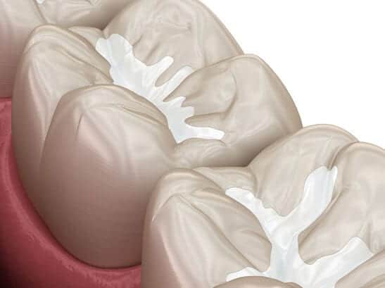 Dental Sealants
