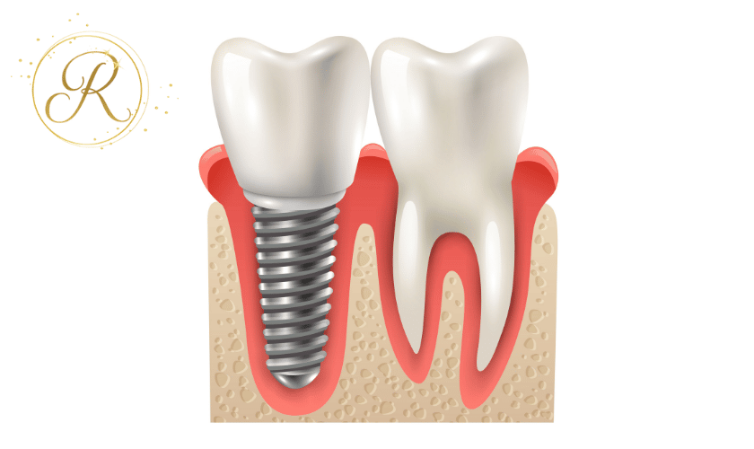 How Long Do Dental Implants Last-radiant-dental-arts