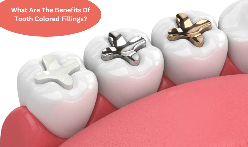 What Are The Benefits Of Tooth Colored Fillings?