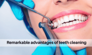Remarkable advantages of teeth cleaning
