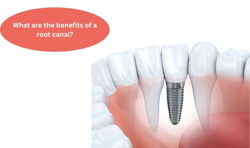 What are the benefits of a root canal?
