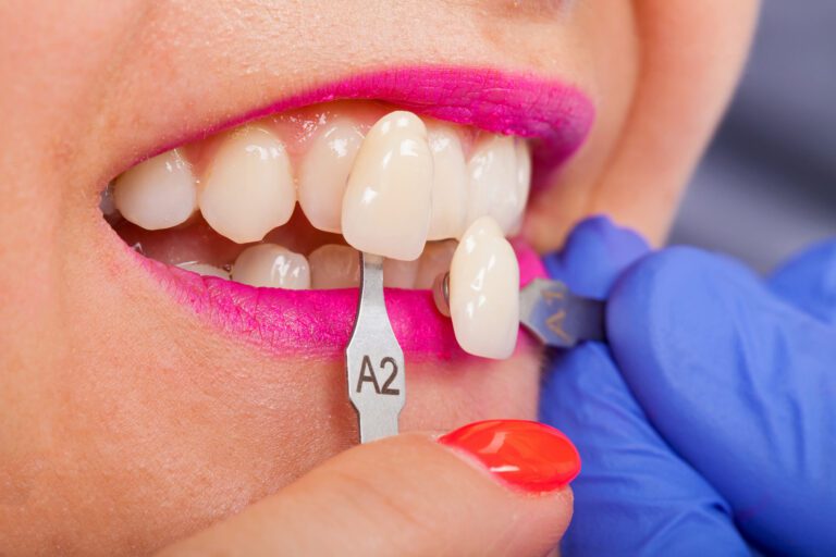 veneers in San Diego